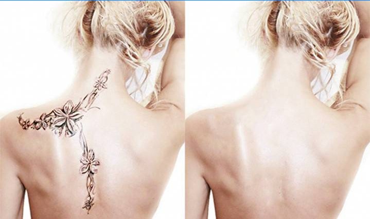 Meisje voor en na het verwijderen van tatoeages