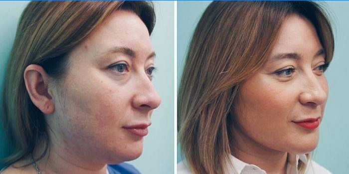 Vrouw voor en na lipolytische injecties