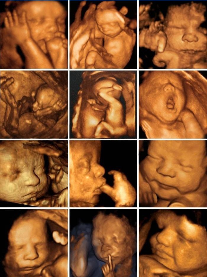 Foto van de foetus na driedimensionale echografie