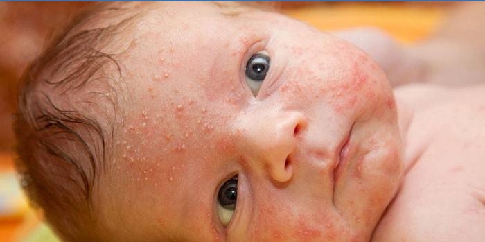 Hormonale uitslag bij een baby op het gezicht