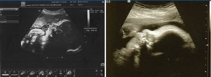 Echografie bij 33 weken zwangerschap