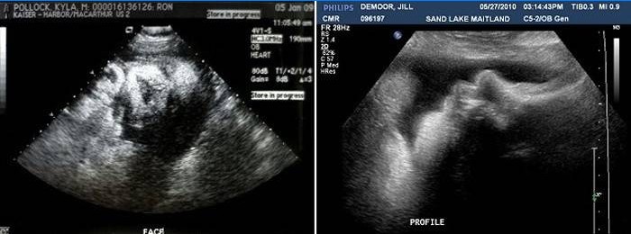 Echografie bij 38 weken zwangerschap