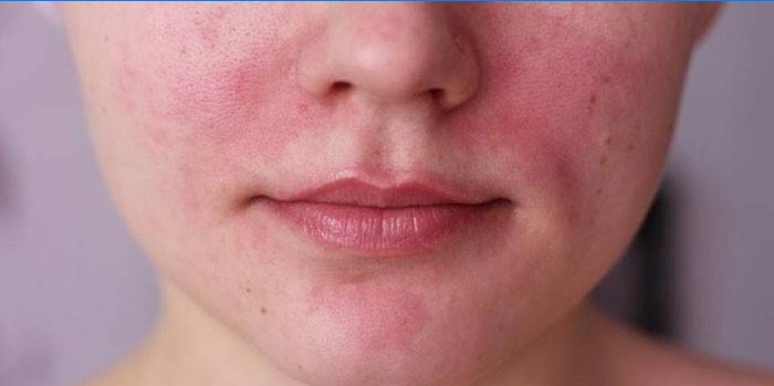 De manifestatie van een allergie op het gezicht
