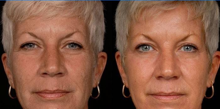 Foto van een vrouw voor en na carboxytherapie