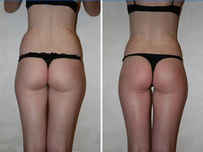 Foto's voor en na lymfedrainage massageprocedures