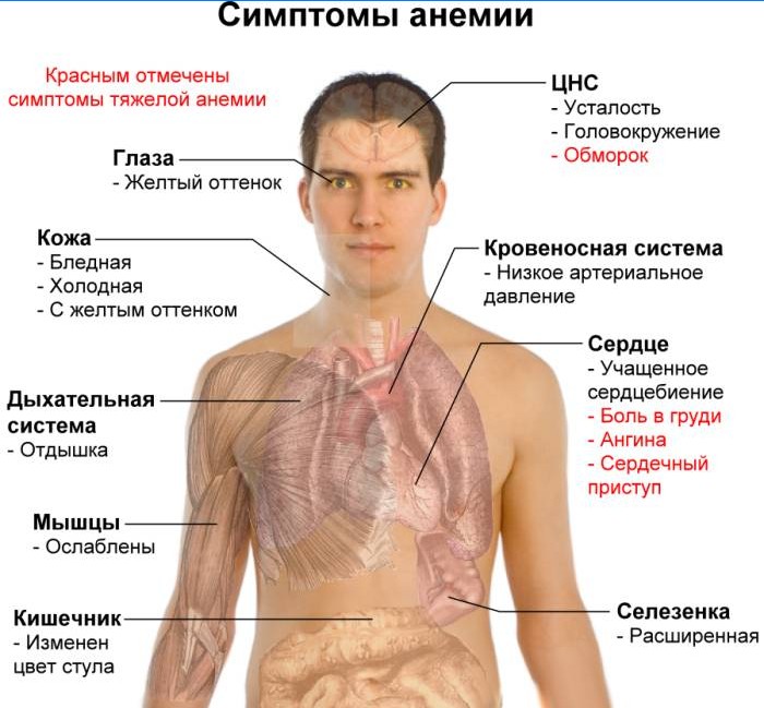 Symptomen van bloedarmoede