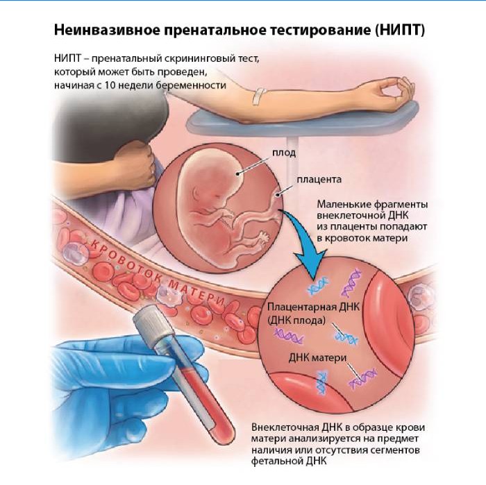 Niet-invasieve prenatale tests (NIPT)