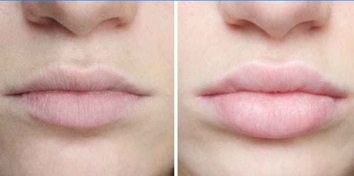 Hyaluronzuur op de lippen voor en na