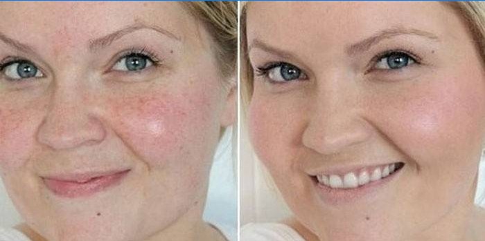 Huid op het gezicht van een vrouw voor en na reiniging door een schoonheidsspecialiste