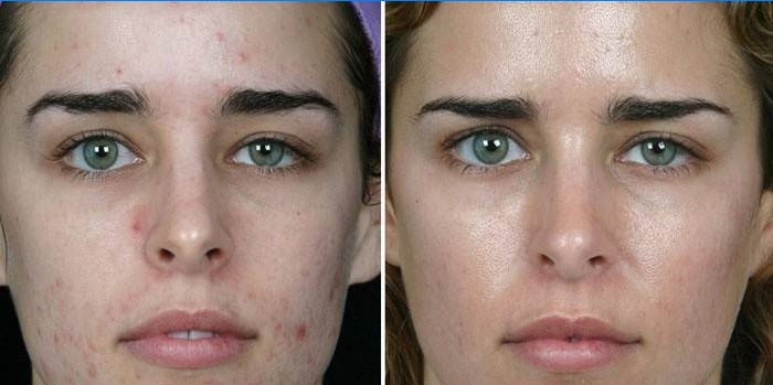 Huid op het gezicht van het meisje voor en na mechanische reiniging door een schoonheidsspecialist