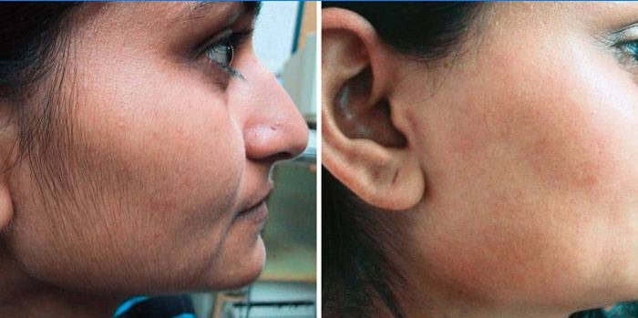 Laserontharing op het gezicht: voor en na foto's