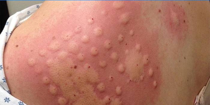 Allergische huidtest