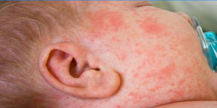 Allergische uitslag op het gezicht van het kind